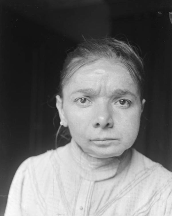 A match factory woman suffering from "phossy jaw."